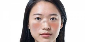 Penyakit Lupus Yang Sering Menyerang Perempuan Asia Serta Hispanik Menurut Lupus Foundation Of America
