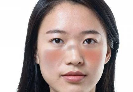 Penyakit Lupus Yang Sering Menyerang Perempuan Asia Serta Hispanik Menurut Lupus Foundation Of America