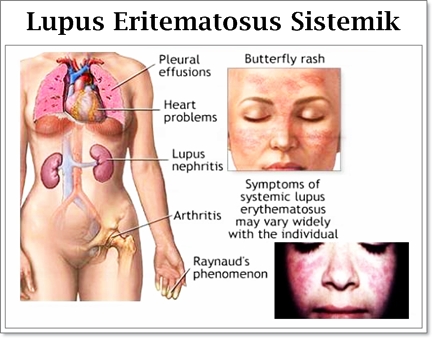 Penjelasan Mengenai Penyakit Systemic Lupus Erythematosus